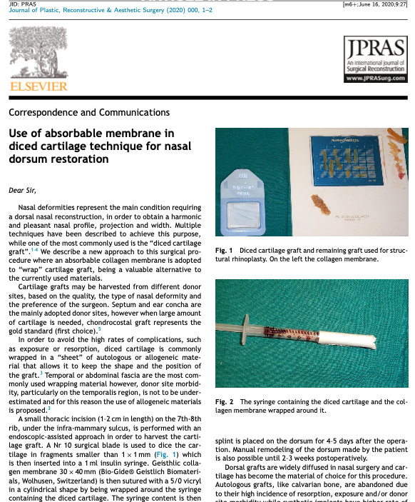 Use of absorbable membrane in diced cartilage technique for nasal dorsum restoration