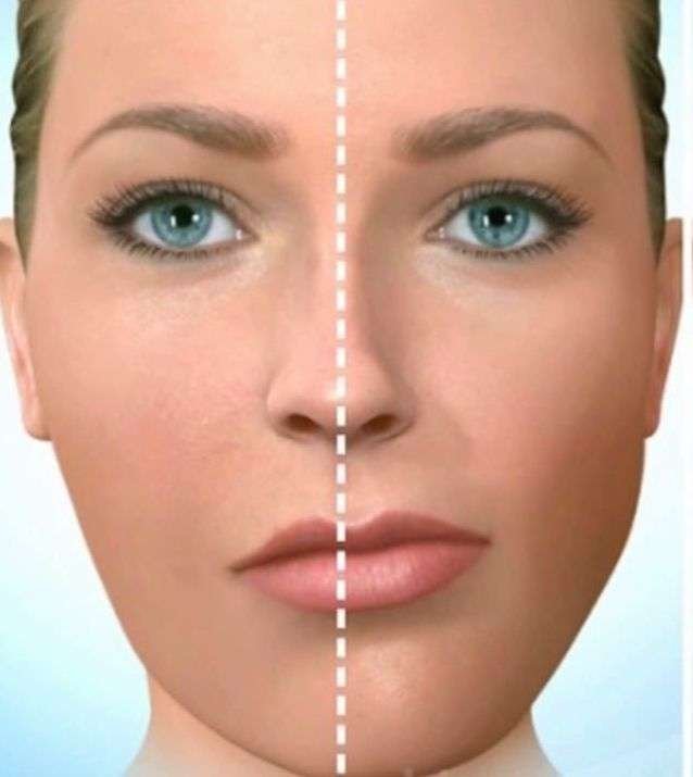 Illustrazione di un volto femminile con deviazione evidente della mandibola e asimmetria facciale.