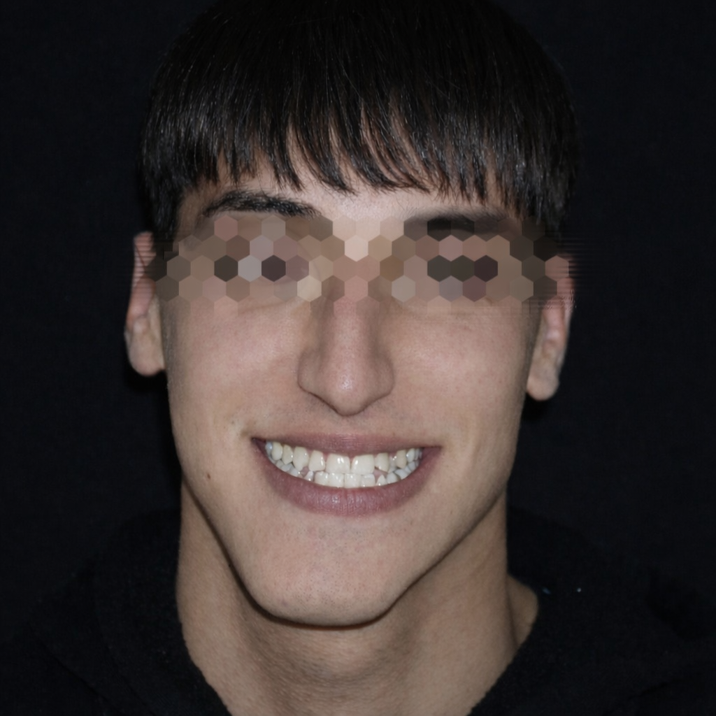 Paziente con asimmetria mandibolare di origine scheletrica, valutata in ambito specialistico.