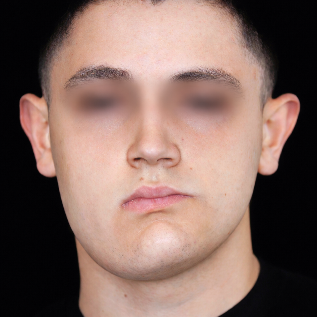 Asimmetria grave del volto e della mandibola – valutazione clinica a Caserta