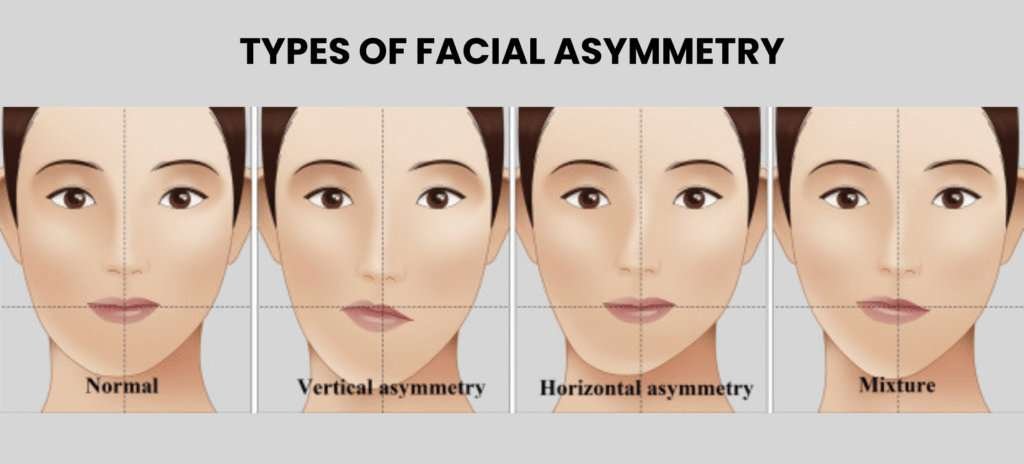 Classificazione delle asimmetrie mandibolari