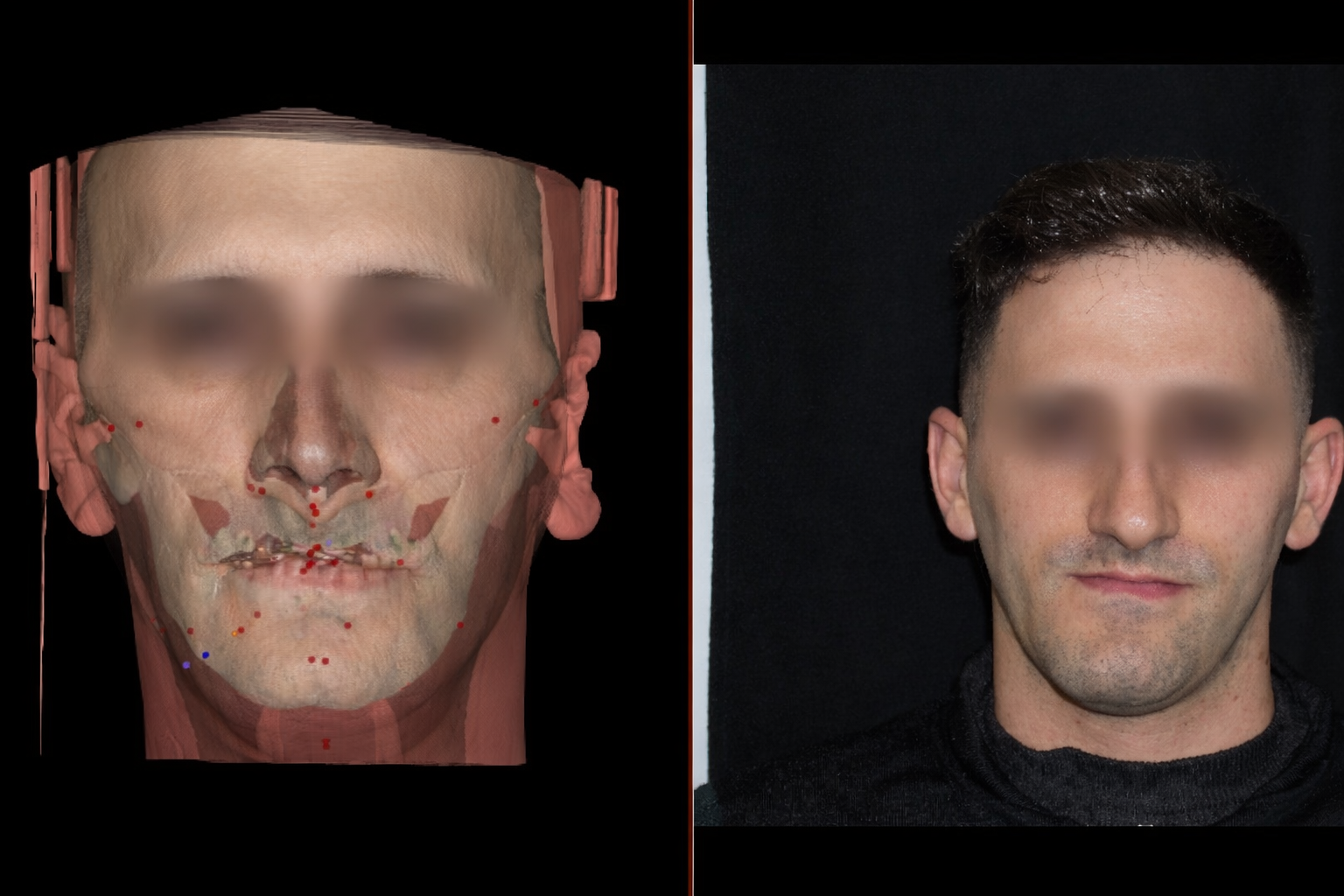 Fotografie standardizzate e modello 3D Cone Beam per la diagnosi dell’asimmetria del volto