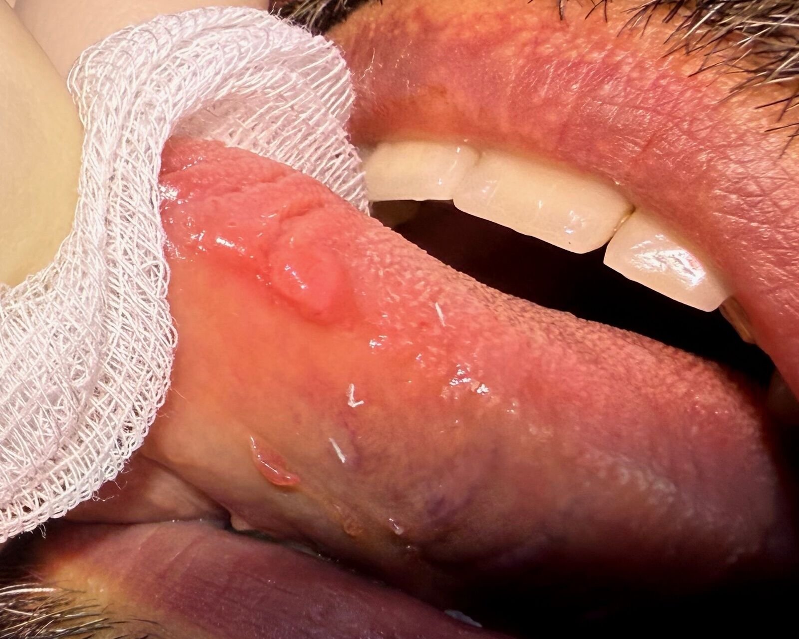 Lesione sul lato della lingua tenuta con una garza, controllo dal chirurgo maxillo-facciale a Caserta