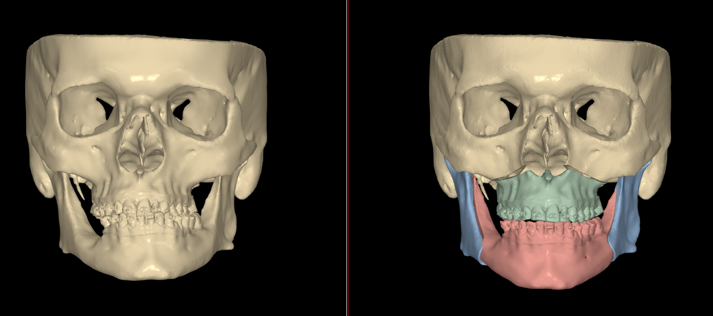 Pianificazione digitale 3D dell’asimmetria mandibolare – Chirurgia Maxillo-Facciale in Campania