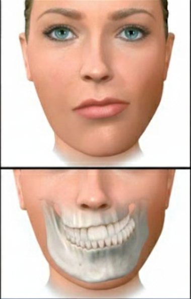 Immagine del volto con asimmetria mandibolare e deviazione del mento, visione clinica laterale.