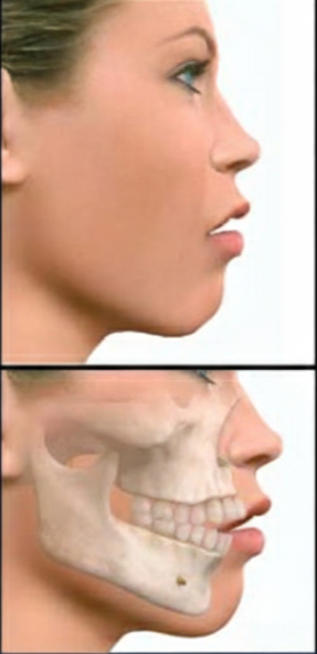 Profilo laterale con morso aperto anteriore e disallineamento dento-scheletrico visibile.