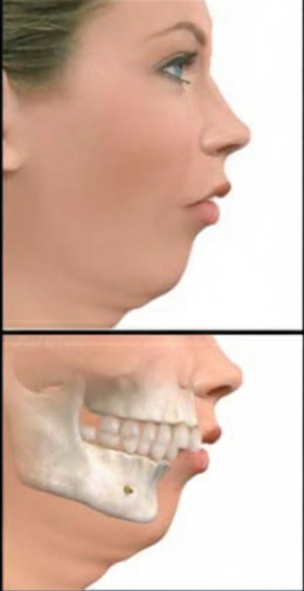 Profilo in seconda classe con mandibola arretrata rispetto alla mascella, visione laterale per la chirurgia ortognatica.